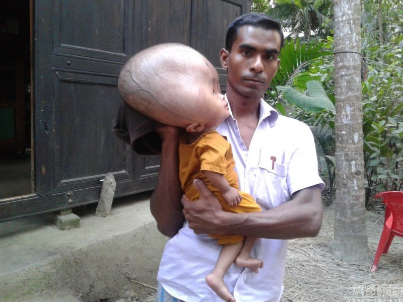 孟加拉国2岁男孩患脑水肿 头重18斤且仍生长